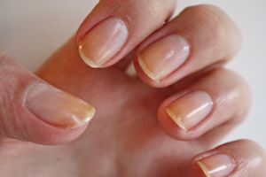 Грибок нігтів: симптоми, засоби від грибка